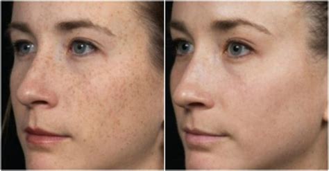 How To Remove Brown Spots On Skin How To Instructions