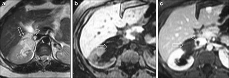Renal Angiomyolipoma In T2 Weighted Mr Axial A Image Is Seen As A