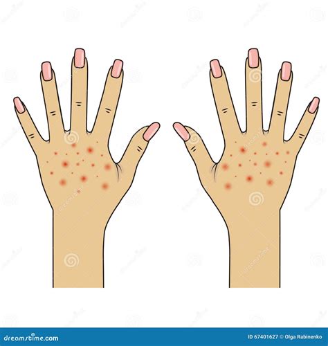 Body Rash Solid Icon Allergy Concept Dermatitis Or Eczema On Body