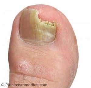 Los hongos que normalmente aparecen en las uñas de los pies no solo son antiestéticos, sino que también pueden ser perjudiciales para la salud y a veces se vuelven verdes, marrones, grises o incluso negras. Remedios caseros para los hongos en las uñas -Plantas ...