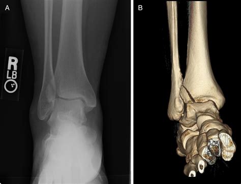 Isolated Adult Tillaux Fracture A Report Of Two Cases The Journal Of
