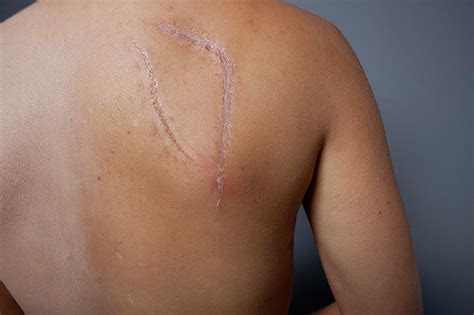 Breast Cancer Surgery Scar Photograph By Larry Dunstan Science Photo