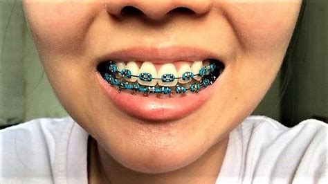 Pin By John Beeson On Orthodontic Braces Braces Colors Color Braces Cute Braces Colors