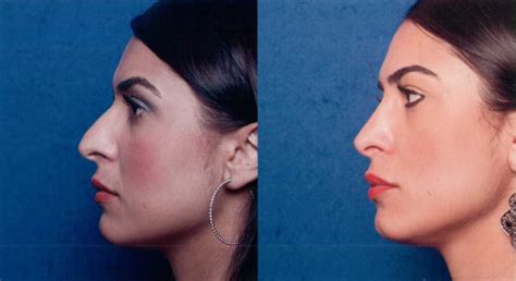 The Nose Clinic Before And After Nose Surgery Photos 50