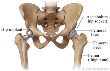 This article will cover hip dislocation, including possible causes and treatments. Partial Hip Replacement: What to Expect at Home