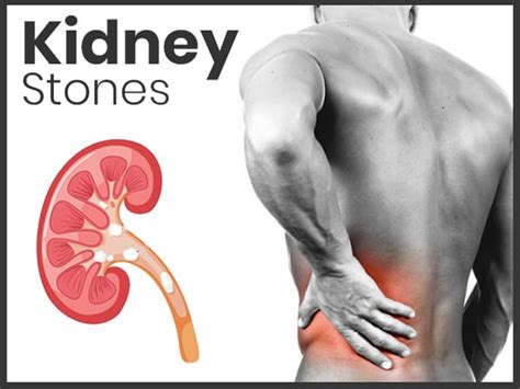 Kidney Stones In Men Symptoms And Treatment Magazines2day
