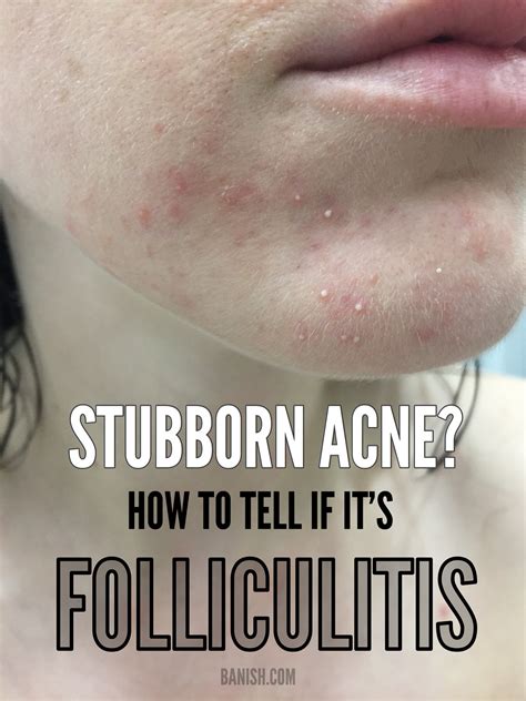 Have Stubborn Acne How To Tell If Its Folliculitis