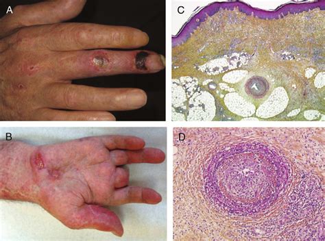 A Necrotic Skin Lesions On A Hand Allograft Developed 11 Years