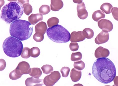 Acute Myelomonocytic Leukemia