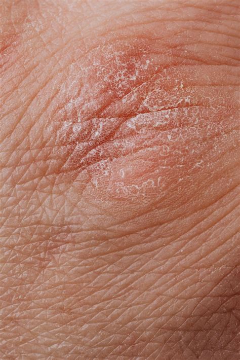 A Guide To Recognizing Morgellons Disease Syndication Cloud