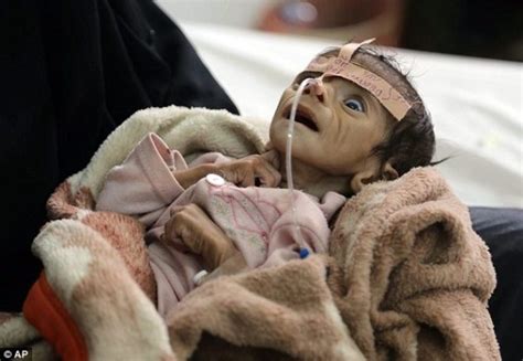 14 Million People Going Hungry In Yemen 370000 Children Suffering