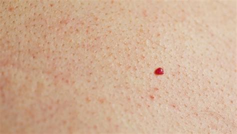 This Is A Cherry Angioma Its Usually Not Serious But If You Notice