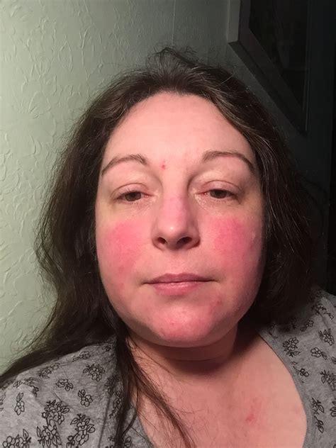 Lupus Can Cause A Red Butterfly Shaped Rash Across The Nose And Cheeks