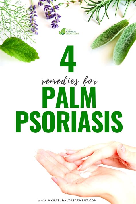 4 Natural Remedies For Palm Psoriasis Psoriasis Skin Remedies