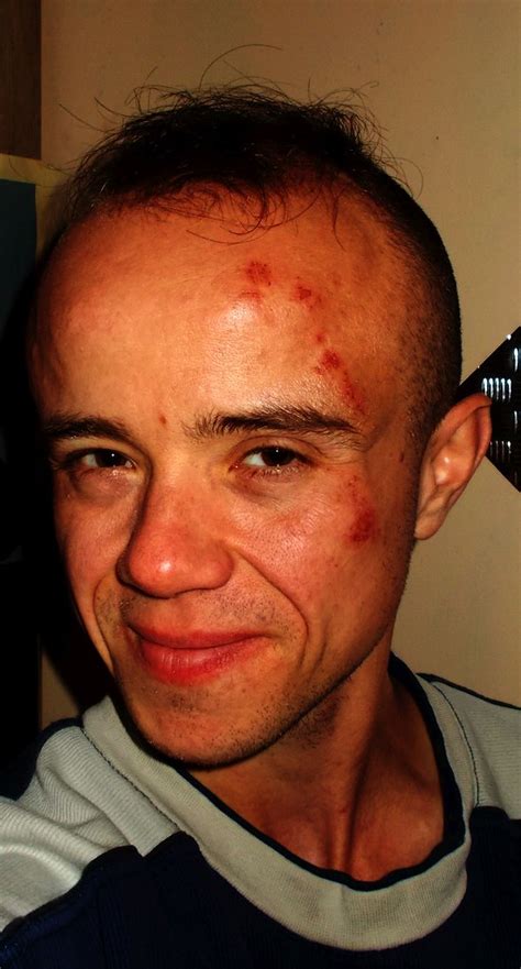 Scraped Face Road Rash Blood Painsnezny Flickr