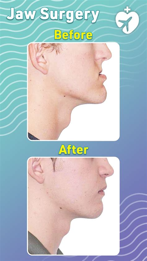 Jaw Surgery Before And After Jaw Surgery Surgery Orthognathic Surgery