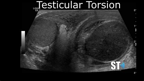 Testicular Scrotal Doppler Protocol Sonographic Tendencies