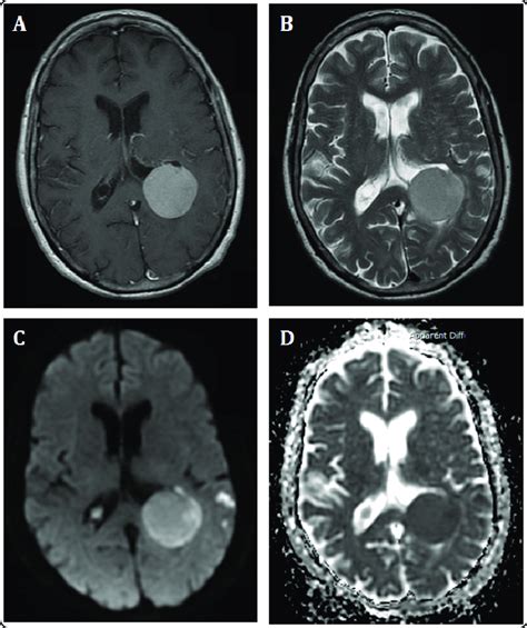 contrast enhanced mri scan of brain showing posterior fossa mass hot sex picture