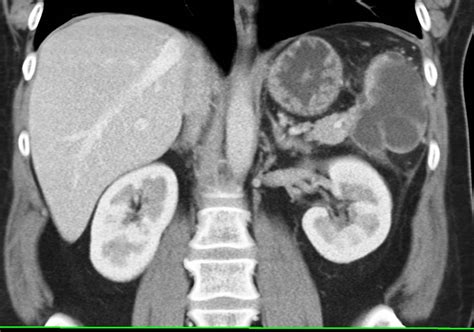 Splenic Pseudocyst As A Result Of Prior Pancreatitis Pancreas Case
