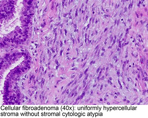 Pathology Outlines Fibroadenoma