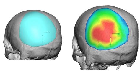 Plastic Surgery Case Study Custom Skull Implant For Male Occipital