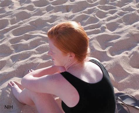 Why Redheads Are More Susceptible To Melanoma Nih Directors Blog
