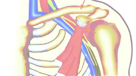 Neurogenic Thoracic Outlet Syndrome Youtube