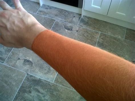 28 Sunburns That Are Really Painful Facepalm Gallery Ebaums World