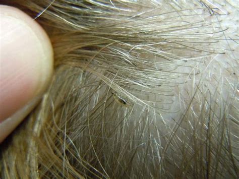 How To Check For Lice And Nits
