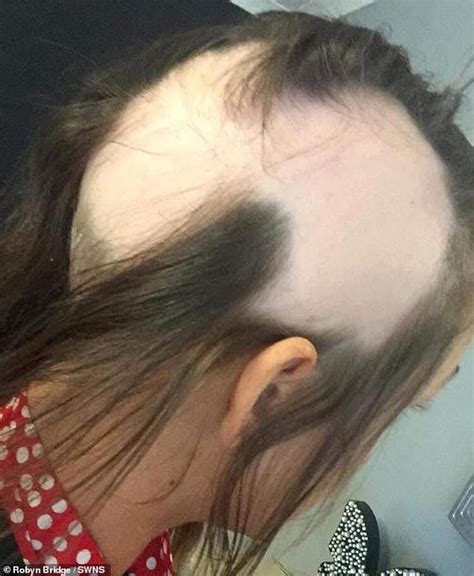 Alopecia Sufferer 27 Sick Of Struggling To Cover Up Her Bald Patches