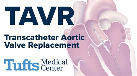 Tavr Transcatheter Aortic Valve Replacement Tufts Medical Center