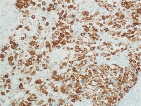 A Immunohistochemical IHC Staining For S100 Protein Shows Patchy