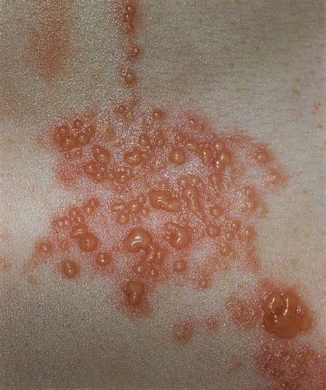Herpes Genital Recognizing The Type On Genital Herpes Treatment