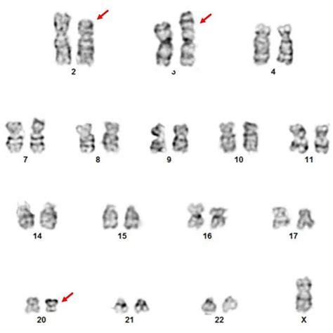 A Representative Karyotype Image Of This Cases The Abnormal