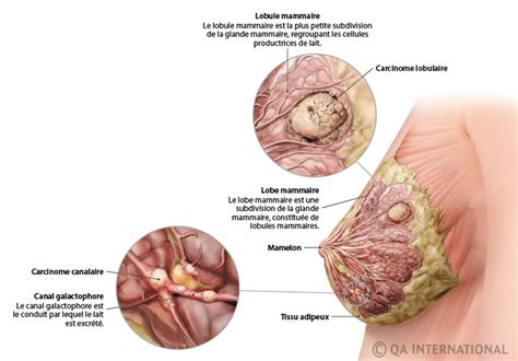 Il est important de pouvoir détecter le plus tôt possible un cancer, car cela peut vous sauver la vie, surtout avec certains types de cancer comme les mélanomes et les carcinomes. Les cancers du sein, bien s'informer pour un avenir rose ...