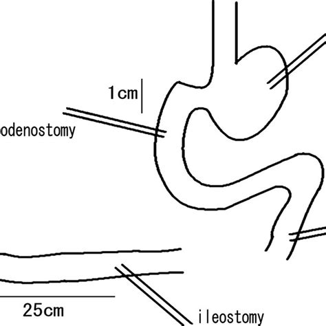 Schematic Presentantion Of The Pancreatico Duodenostomy Download