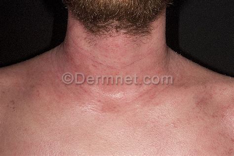 Mild Atopic Dermatitis Neck Eczema Free Skin