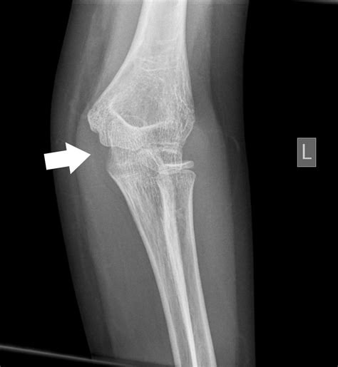 Cureus A Rare Case Of Traumatic Bilateral Elbow Dislocation Without A