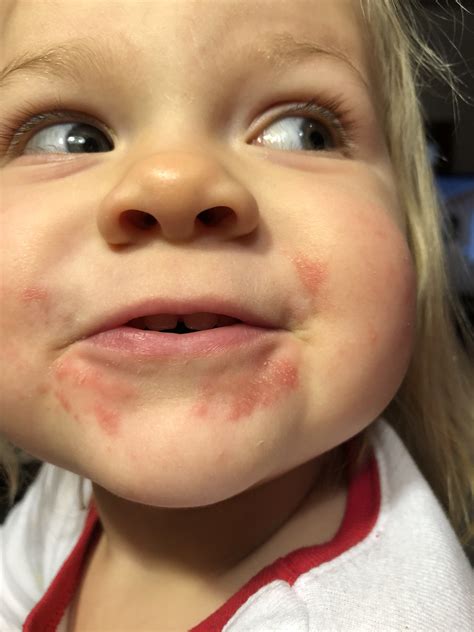 Allergy Trigger Red Rash Around Mouth Baby After Eating