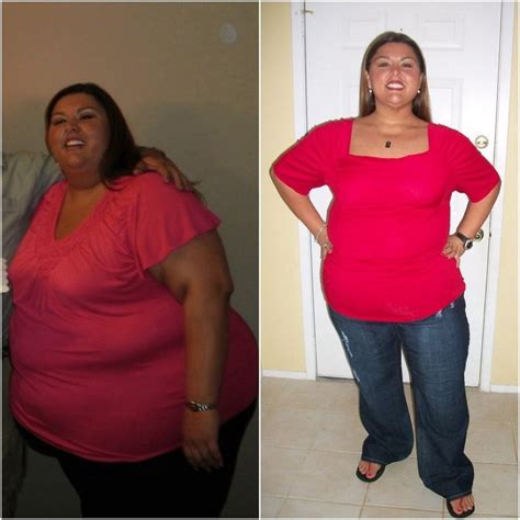Heavy Weight Loss Foley Woman Drops 178 Pounds For Aande