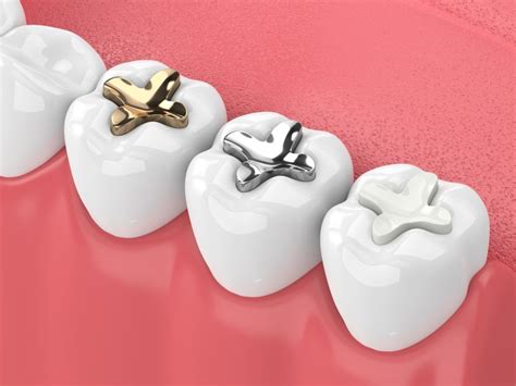 Tooth Fillings And Sealants La Vista Ne Nebraska Dental Center