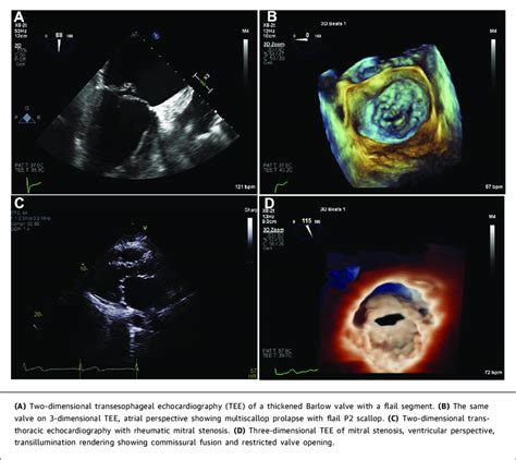 Transesophageal Echocardiography Of A Barlow Mitral Valve And Rheumatic