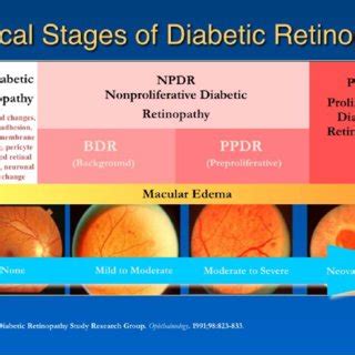 Diabetic retinopathy is prevalent in patients with dfu and about half of dfu patients had pdr. Stages of progression of diabetic retinopathy. Image ...