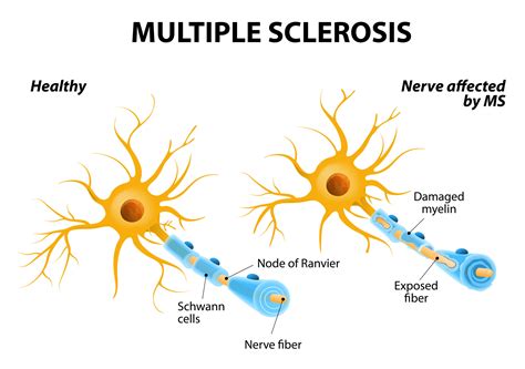 Multiple Sclerosis Symptoms Causes And Treatment Vrogue Co