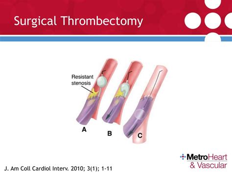 PPT Arteriovenous Fistulas Types Trends Physical Examination Treatment PowerPoint