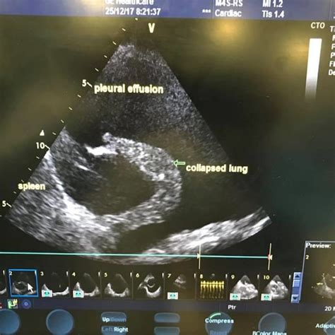 Ultrasound Chest Shows Left Pleural Effusion This Scan Shows