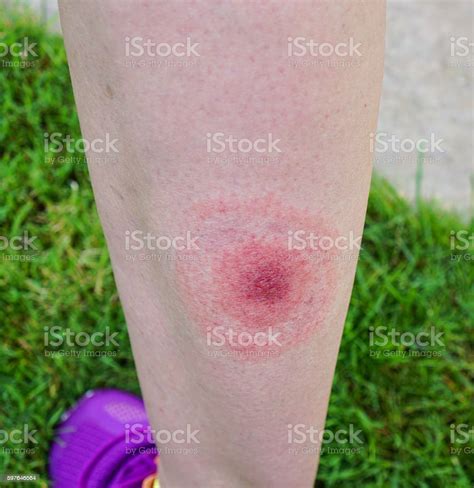 Lyme Disease Borreliosis Or Borrelia Typical Lyme Rash Spot Stock Photo