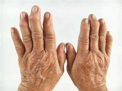 Low Dose Radiotherapy May Reduce Pain In Finger Osteoarthritis