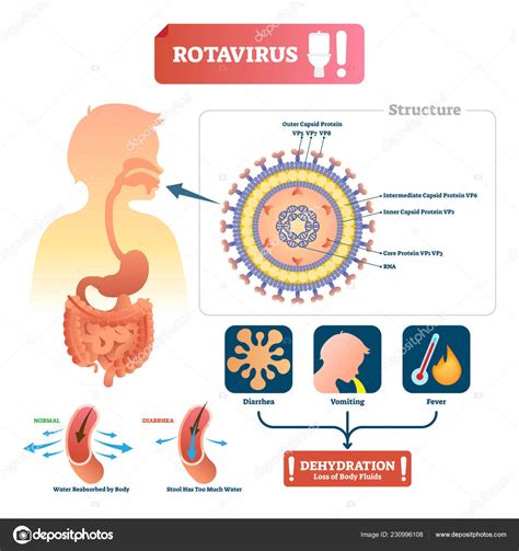 That's because infection starts a few days before symptoms do. Rotavirus vector illustration. Labeled stomach medical ...