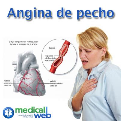 Cuáles son las características de la angina de pecho Las Fijas de